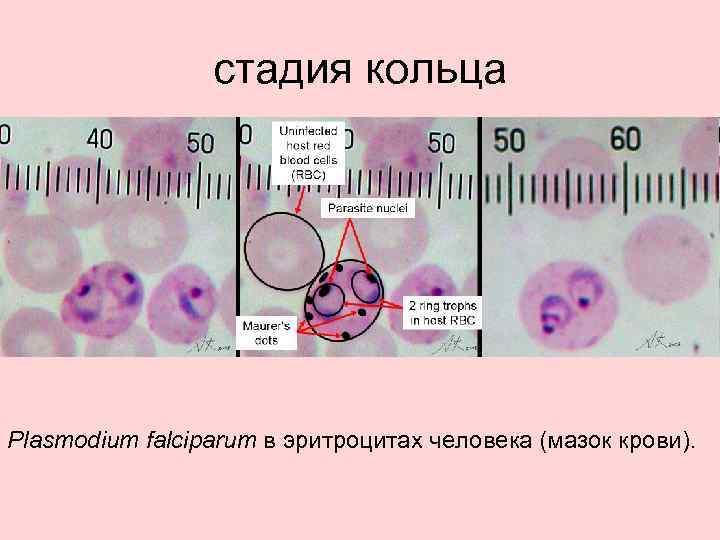 стадия кольца Plasmodium falciparum в эритроцитах человека (мазок крови). 