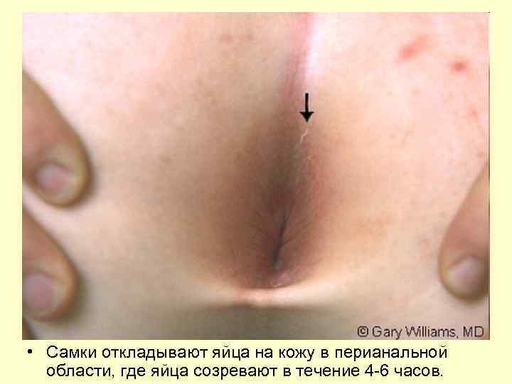  • Cамки откладывают яйца на кожу в перианальной области, где яйца созревают в