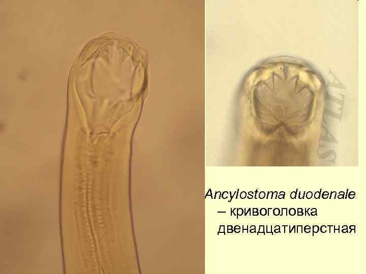 Ancylostoma duodenale – кривоголовка двенадцатиперстная 