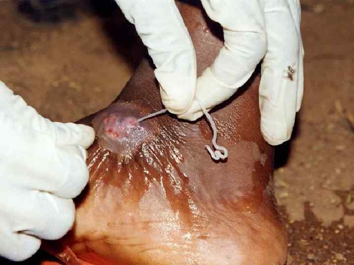 female Guinea worm, Dracunculus medinensis, from a sufferer 