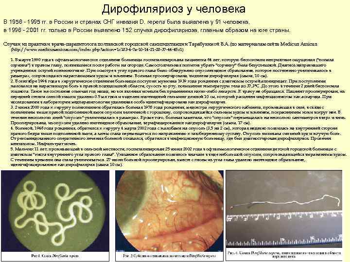 Дирофиляриоз у человека В 1956 - 1995 гг. в России и странах CHГ инвазия