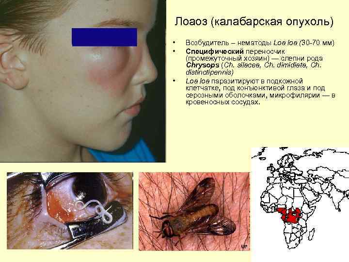 Лоаоз (калабарская опухоль) • • • Возбудитель – нематоды Loa loa (30 -70 мм)