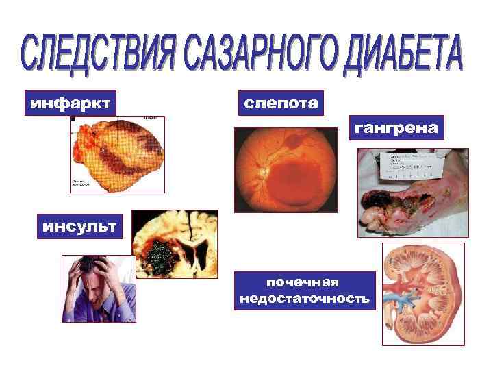 инфаркт слепота гангрена инсульт почечная недостаточность 