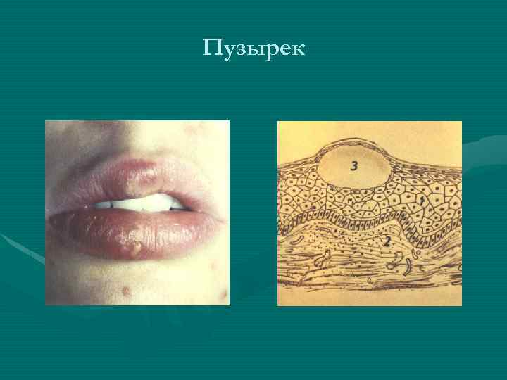 Пузырек 
