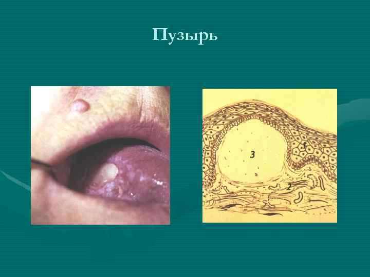 Пузырь 