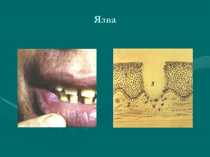 Язва 