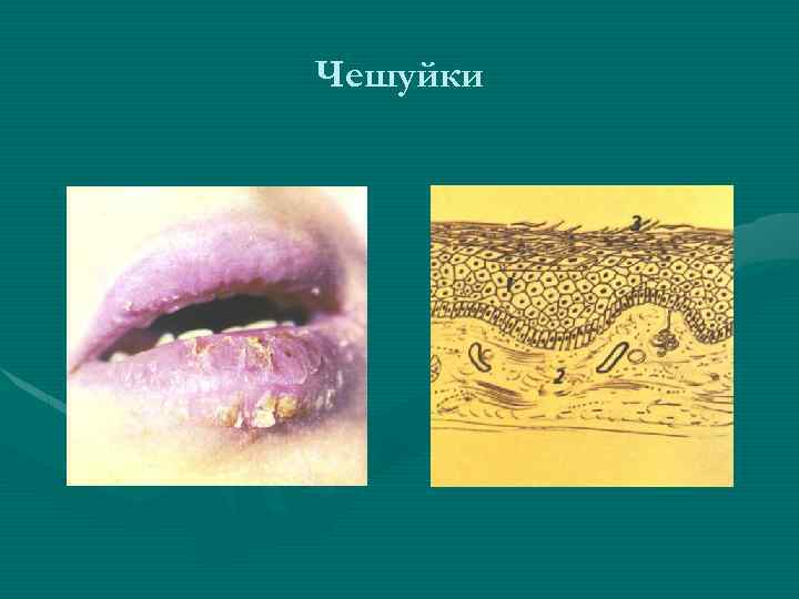 Чешуйки 