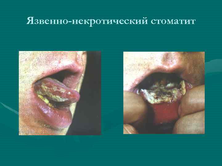 Язвенно-некротический стоматит 