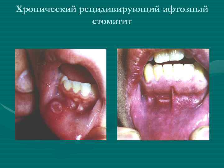 Хронический рецидивирующий афтозный стоматит 
