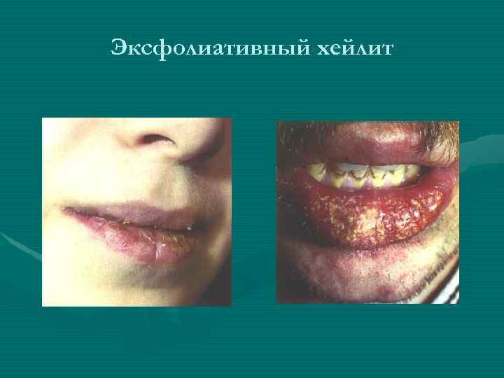 Эксфолиативный хейлит 