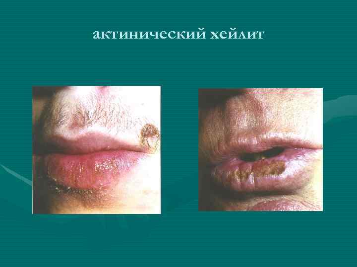 актинический хейлит 