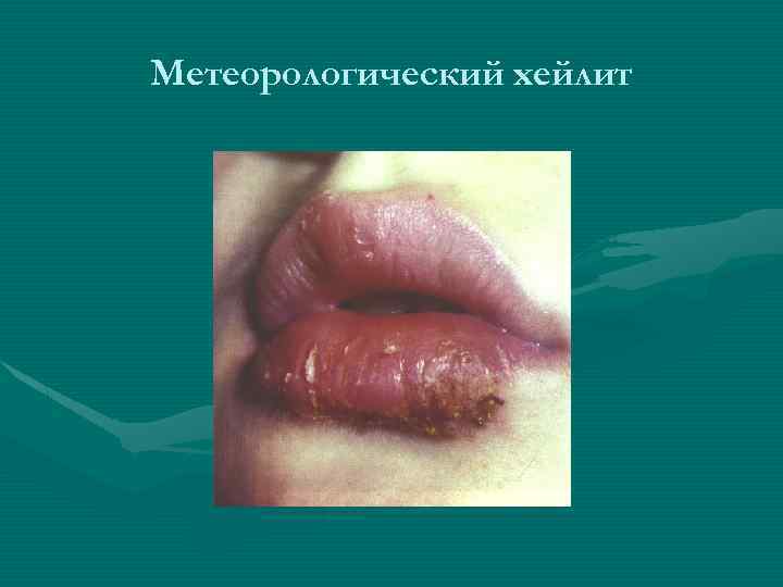 Метеорологический хейлит 