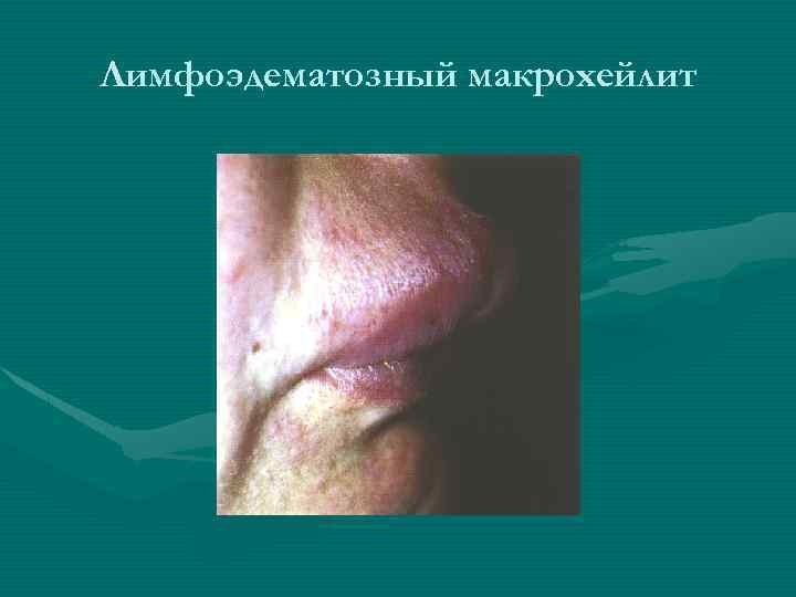 Лимфоэдематозный макрохейлит 