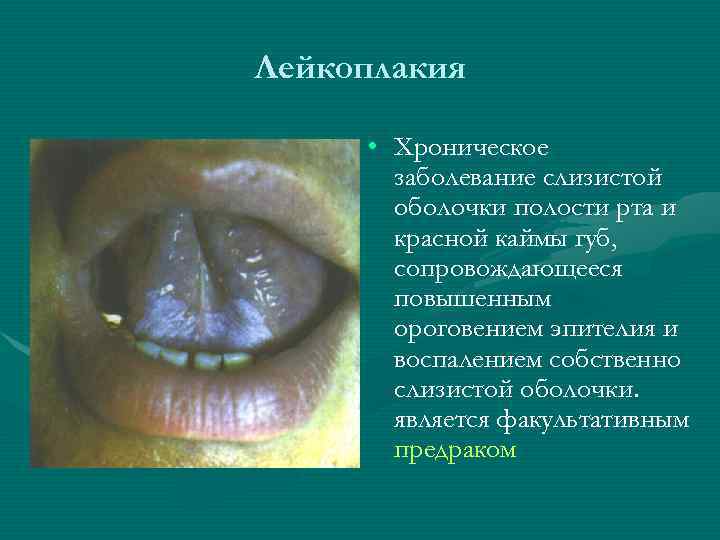 Лейкоплакия • Хроническое заболевание слизистой оболочки полости рта и красной каймы губ, сопровождающееся повышенным