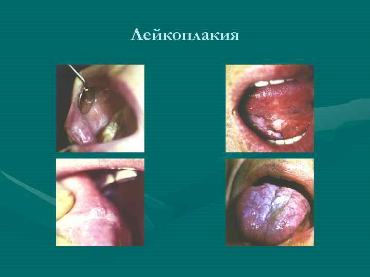 Лейкоплакия 