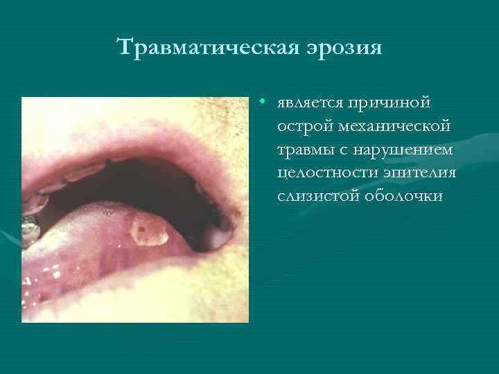 Травматическая эрозия • является причиной острой механической травмы с нарушением целостности эпителия слизистой оболочки
