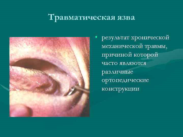 Травматическая язва • результат хронической механической травмы, причиной которой часто являются различные ортопедические конструкции