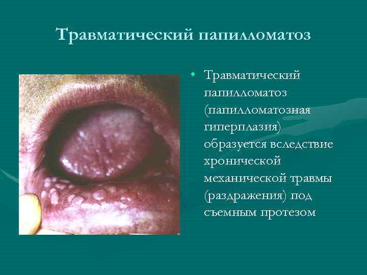 Травматический папилломатоз • Травматический папилломатоз (папилломатозная гиперплазия) образуется вследствие хронической механической травмы (раздражения) под