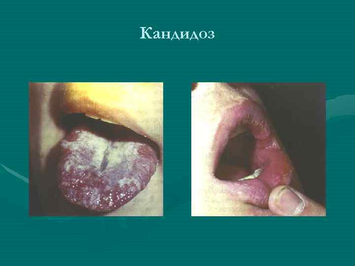 Кандидоз 
