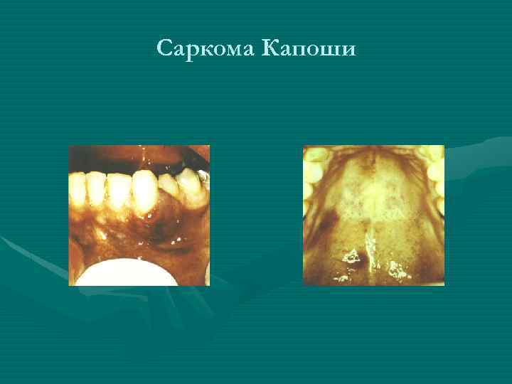 Саркома Капоши 