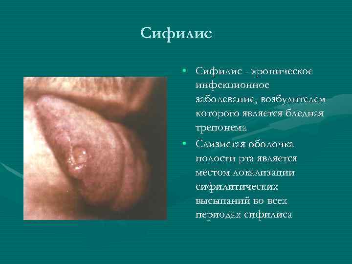 Сифилис • Сифилис - хроническое инфекционное заболевание, возбудителем которого является бледная трепонема • Слизистая