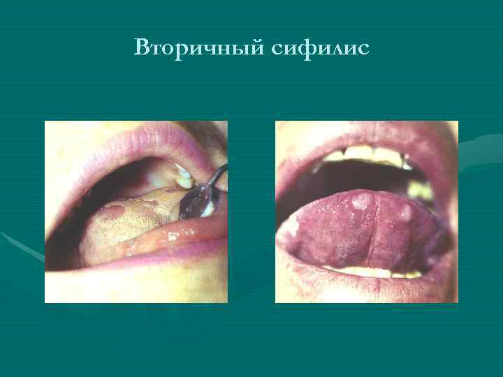 Вторичный сифилис 