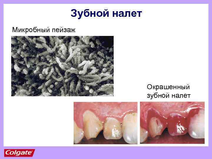 Зубной налет Микробный пейзаж Окрашенный зубной налет 
