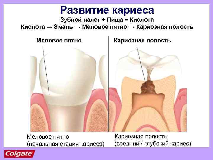 Развитие кариеса Зубной налет + Пища = Кислота → Эмаль → Меловое пятно →
