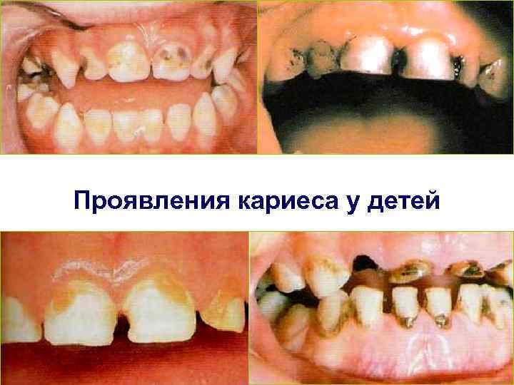Проявления кариеса у детей 