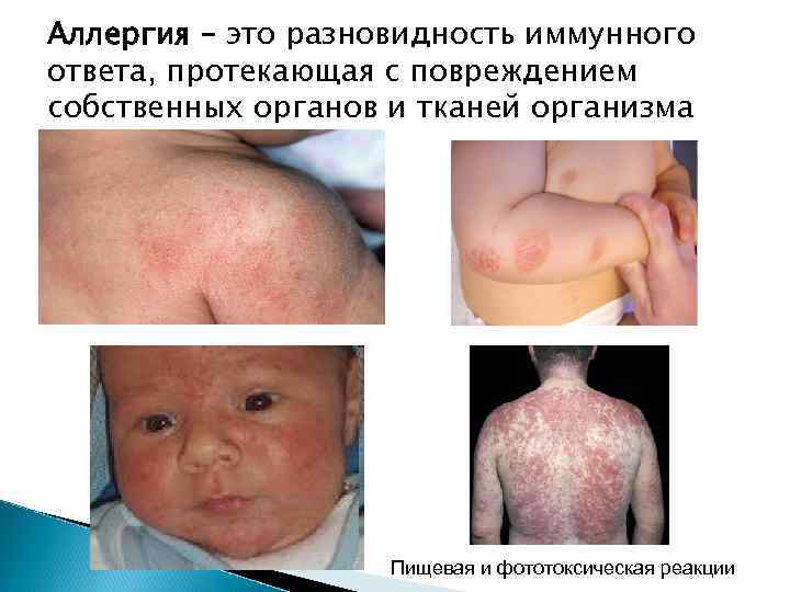 Аллергия – это разновидность иммунного ответа, протекающая с повреждением собственных органов и тканей организма