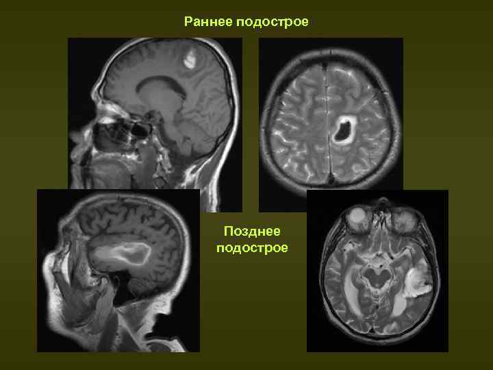 Подострая стадия ишемического инсульта. Стадии ишемического инсульта на кт. Поздняя подострая стадия ишемического. K A Hossman 1989 формирование инфаркта мозга Пенумбра.