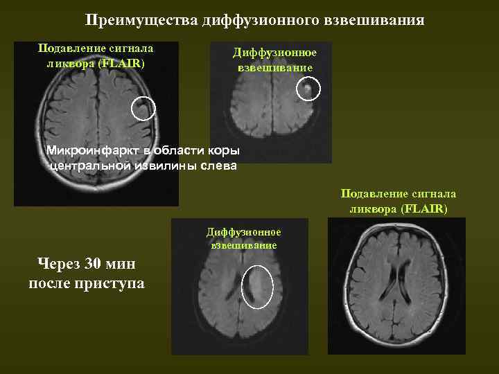 Диффузионно взвешенное изображение