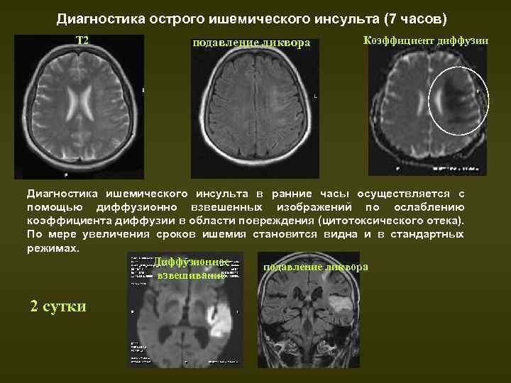 Стол после ишемического инсульта