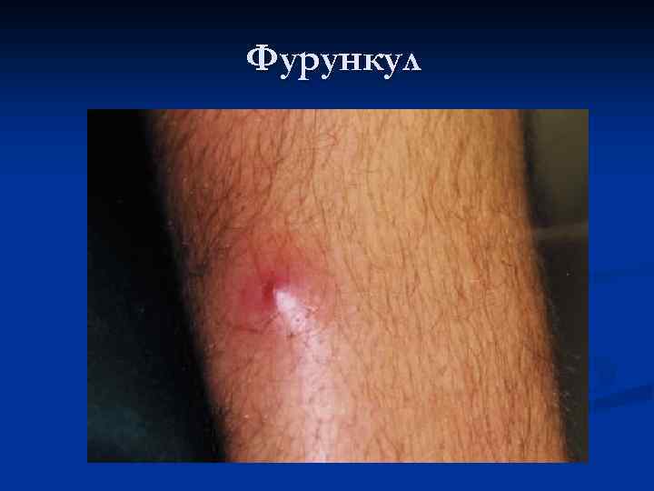 Фурункул 