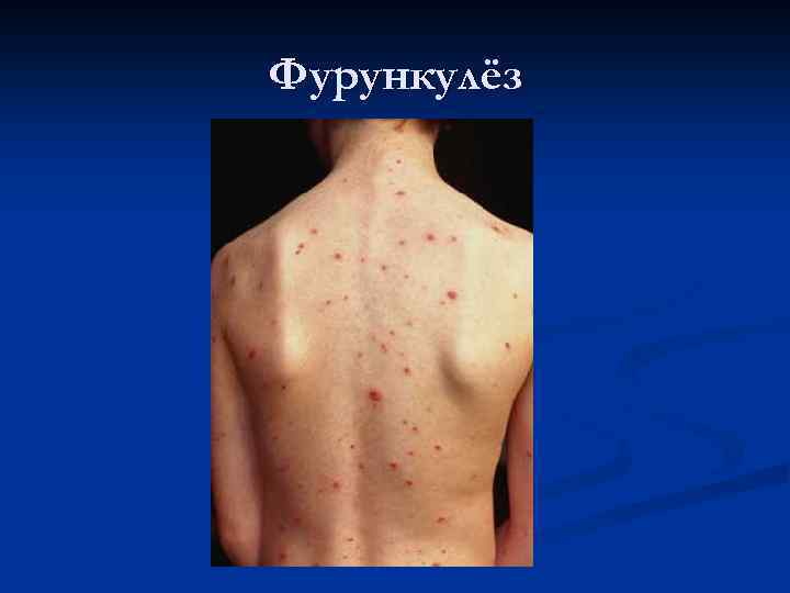 Фурункулёз 