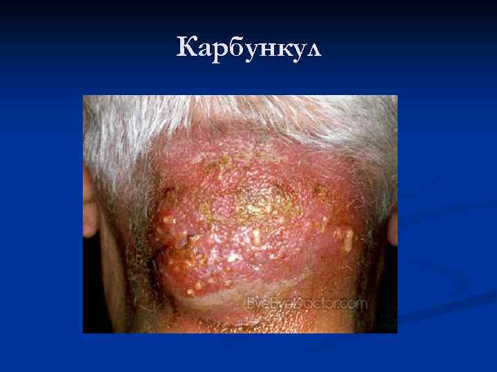 Карбункул 