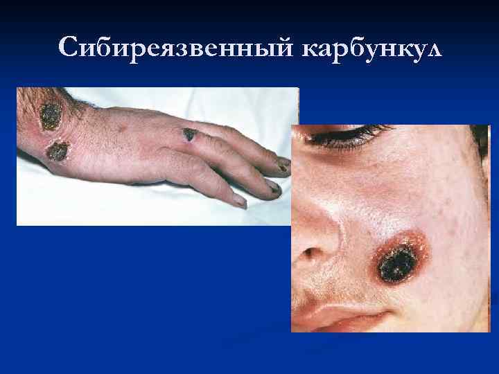 Сибиреязвенный карбункул 