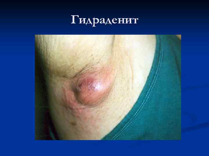 Гидраденит 