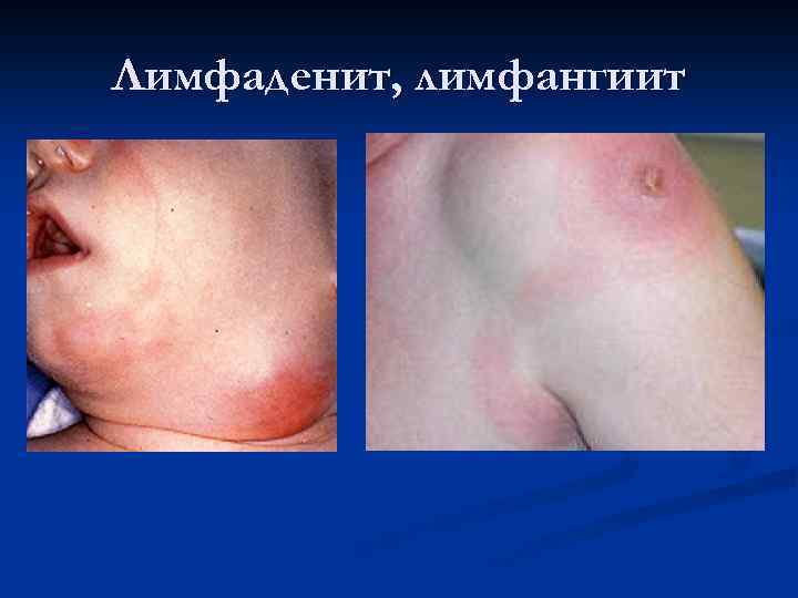 Лимфаденит, лимфангиит 