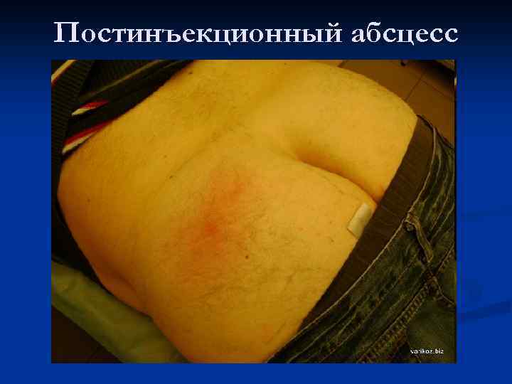Постинъекционный абсцесс 