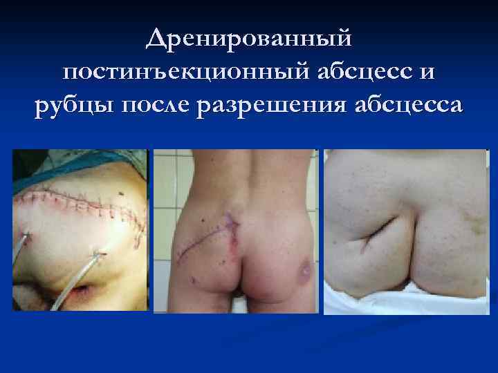 Дренированный постинъекционный абсцесс и рубцы после разрешения абсцесса 