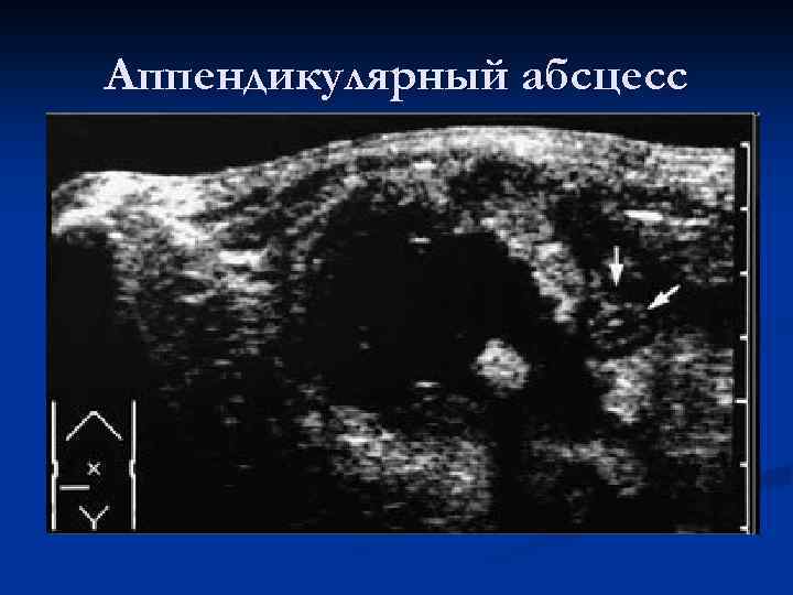 Аппендикулярный абсцесс 
