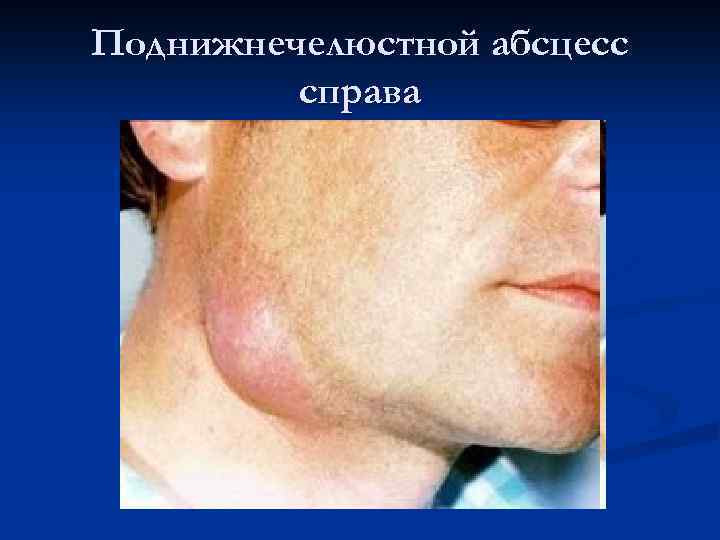 Поднижнечелюстной абсцесс справа 