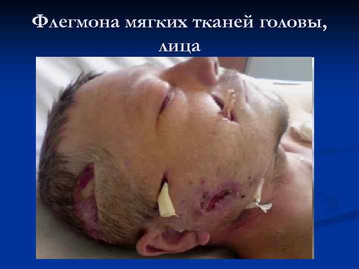 Флегмона мягких тканей головы, лица 