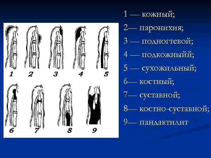 1 — кожный; 2— паронихия; 3 — подногтевой; 4 — подкожныйй; 5 — сухожильный;