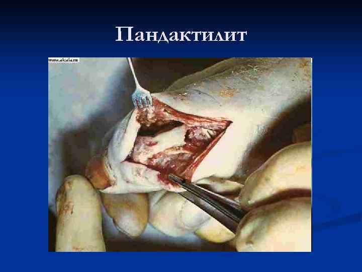 Пандактилит 