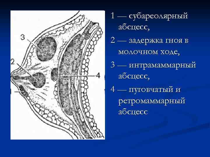 1 — субареолярный абсцесс, 2 — задержка гноя в молочном ходе, 3 — интрамаммарный