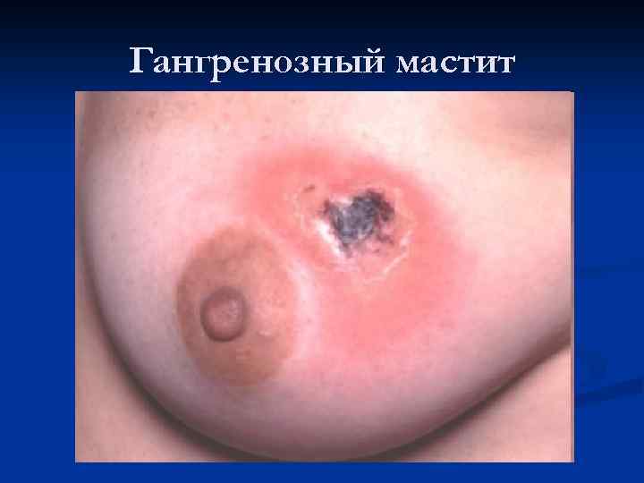 Гангренозный мастит 