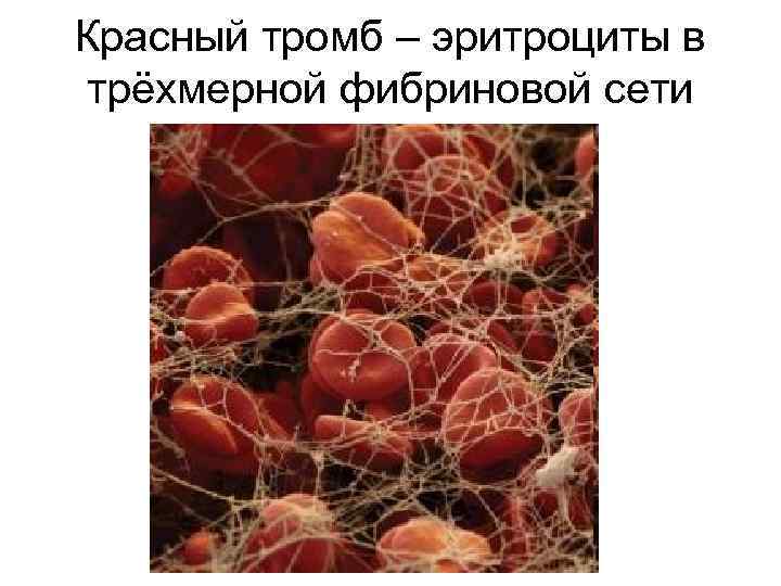 Красный тромб – эритроциты в трёхмерной фибриновой сети 