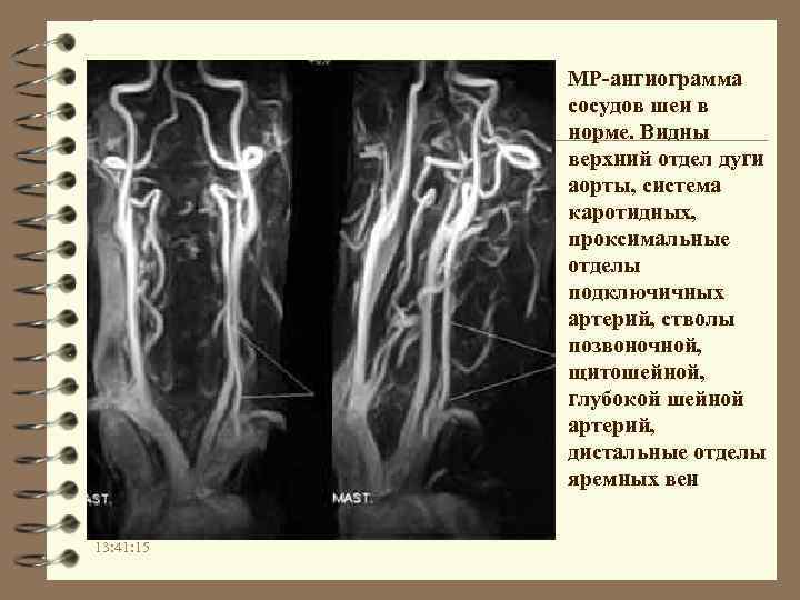 МР-ангиограмма сосудов шеи в норме. Видны верхний отдел дуги аорты, система каротидных, проксимальные отделы